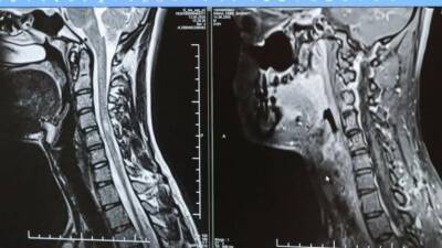 MS (Multiple Skeleroz) hastalığının her bireyde farklı bir şekilde gelişebileceğinin
