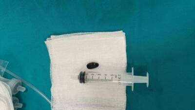 BATMAN (AA) – Batman’da akciğerine çekirdek kabuğu kaçan 15 aylık