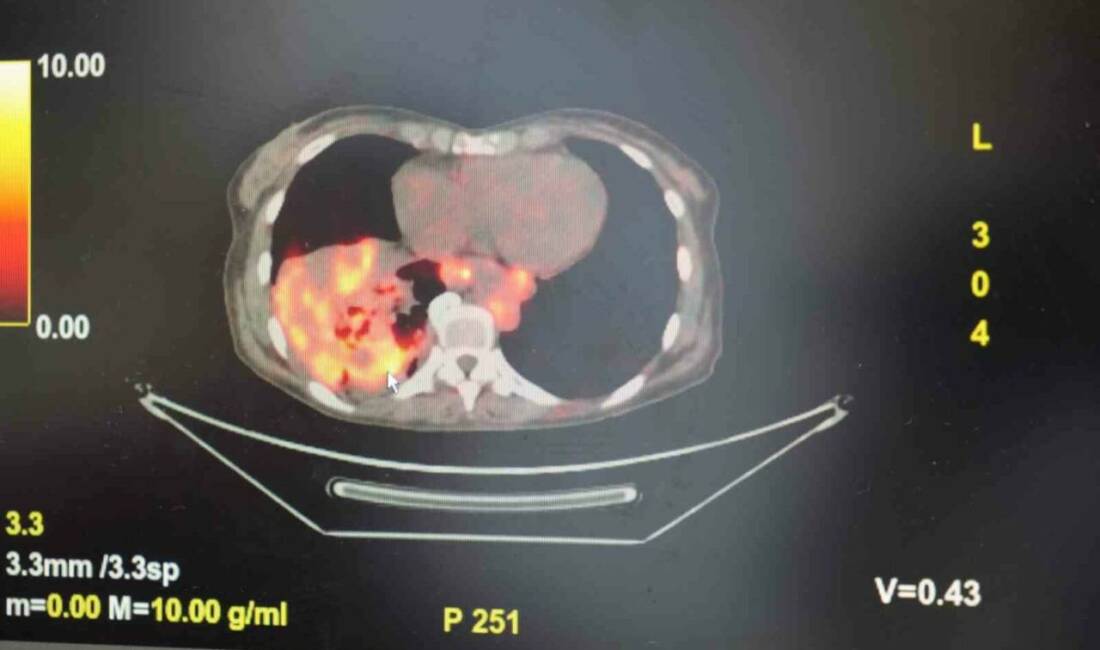 Göğüs Hastalıkları Uzmanı Prof. Dr. Şevket Özkaya, son yıllarda sigara